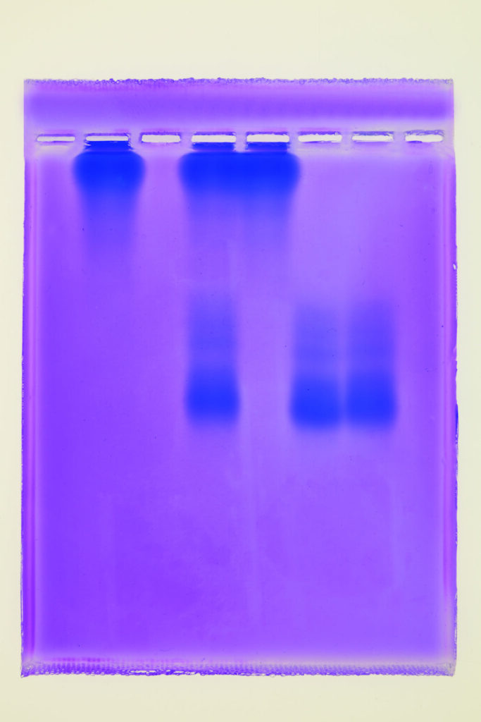 सिकल-सेल प्रयोगशाला गतिविधि के लिए वार्ड साइंस हीमोग्लोबिन स्क्रीनिंग से बैंगनी ट्रैकिंग शीट का एक नमूना