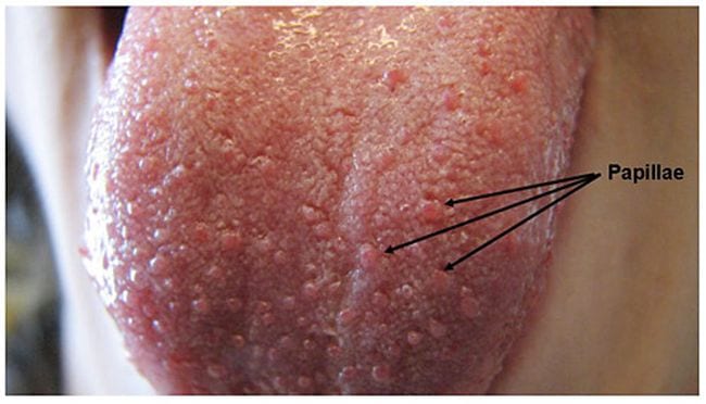 Human tongue with an arrow pointing to the papillae